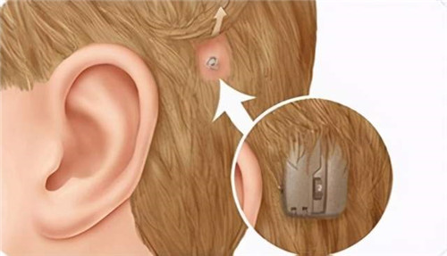 骨锚式助听器